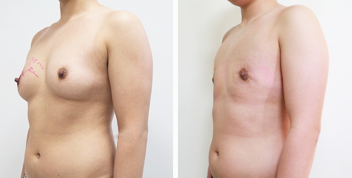 Chirurgie du Torse / Mastectomie 37 lg 64949599a2735 image