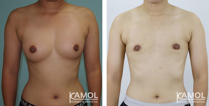 Chirurgie du Torse / Mastectomie 40 lg 64949599a5640 image