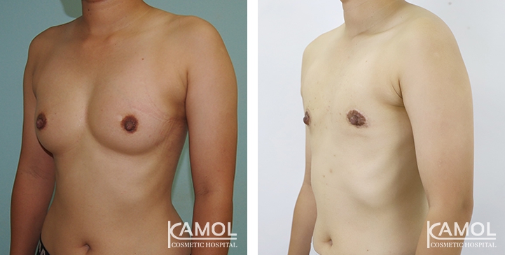 Chirurgie du Torse / Mastectomie 44 lg 64949599a76d9 image
