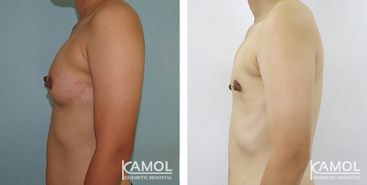 Chirurgie du Torse / Mastectomie 43 lg 64949599a9886 image