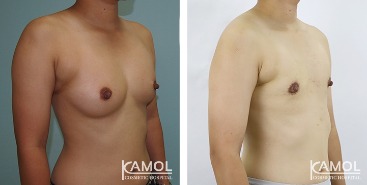 Chirurgie du Torse / Mastectomie 42 lg 64949599ab863 image