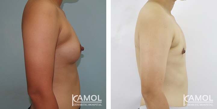 Chirurgie du Torse / Mastectomie 41 lg 64949599ad78d image