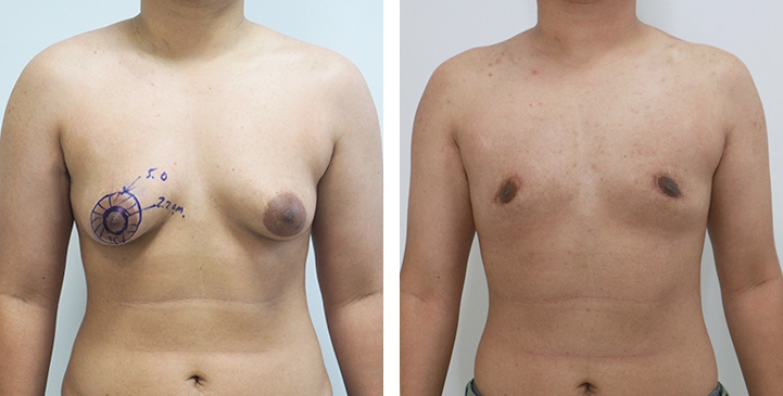 Chirurgie du Torse / Mastectomie 46 lg 64949599b0409 image