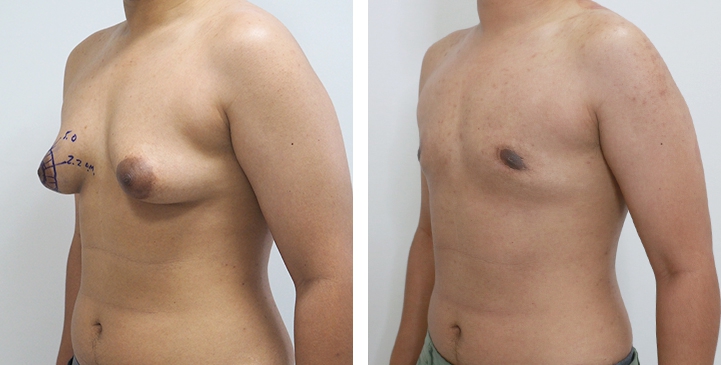 Chirurgie du Torse / Mastectomie 50 lg 64949599b24a1 image