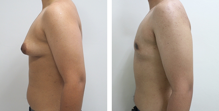 Chirurgie du Torse / Mastectomie 49 lg 64949599b45d6 image