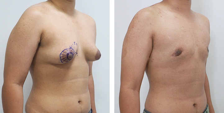 Chirurgie du Torse / Mastectomie 48 lg 64949599b6610 image