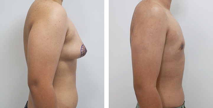 Chirurgie du Torse / Mastectomie 47 lg 64949599b8799 image