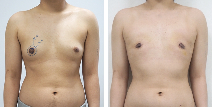 Chirurgie du Torse / Mastectomie 52 lg 64949599bb747 image