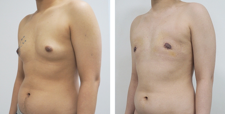 Chirurgie du Torse / Mastectomie 56 lg 64949599bd888 image