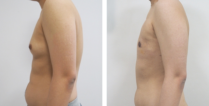 Chirurgie du Torse / Mastectomie 55 lg 64949599bfa00 image