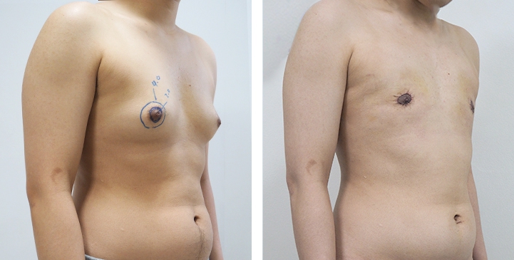 Chirurgie du Torse / Mastectomie 53 lg 64949599c3654 image