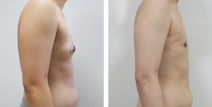 Chirurgie du Torse / Mastectomie 54 lg 64949599c5a09 image