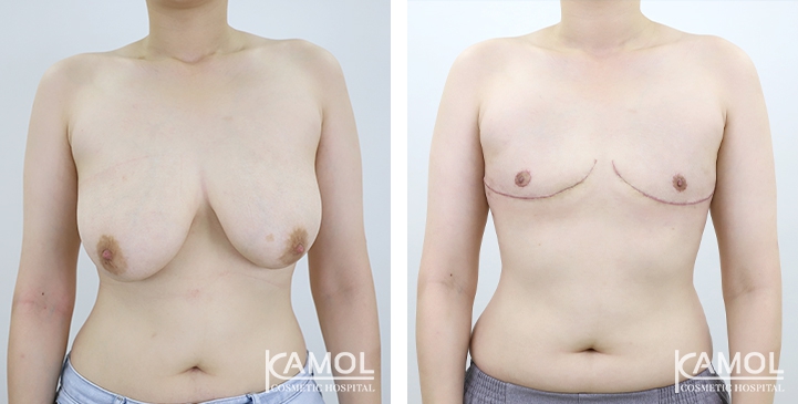Chirurgie du Torse / Mastectomie 62 lg 64949599c85da image