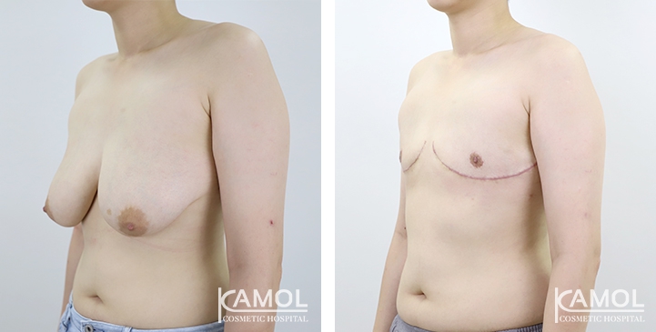 Chirurgie du Torse / Mastectomie 61 lg 64949599cbbb6 image
