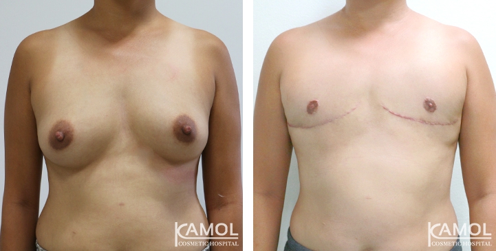 Chirurgie du Torse / Mastectomie 64 lg 64949599d45de image