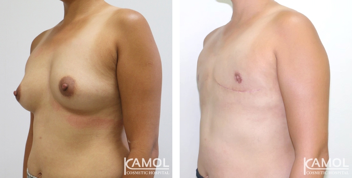 Chirurgie du Torse / Mastectomie 67 lg 64949599d6681 image