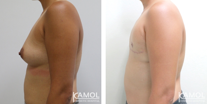 Chirurgie du Torse / Mastectomie 68 lg 64949599d867c image