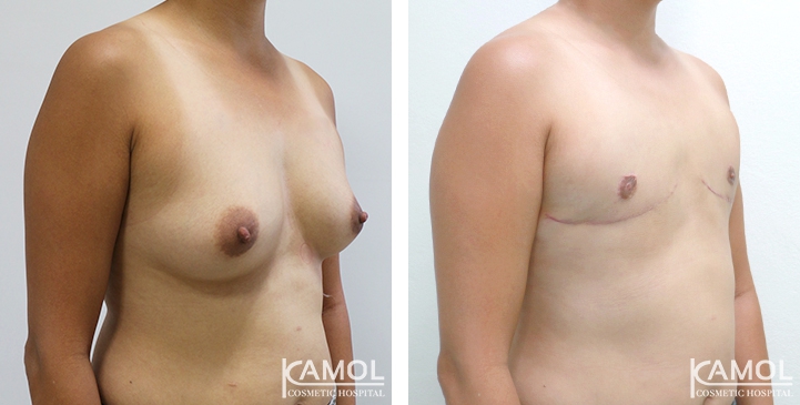 Chirurgie du Torse / Mastectomie 66 lg 64949599da8f7 image