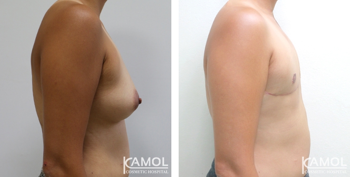Chirurgie du Torse / Mastectomie 65 lg 64949599dc9a6 image