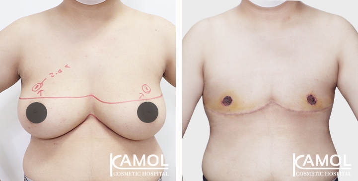 Chirurgie du Torse / Mastectomie 72 lg 64949599df4aa image