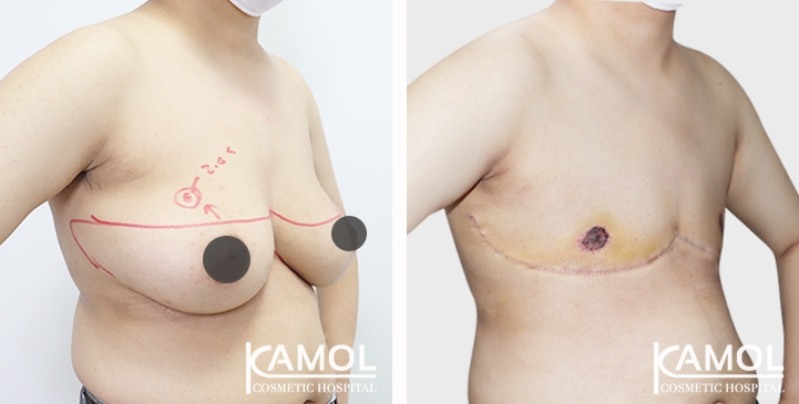 Chirurgie du Torse / Mastectomie 70 lg 64949599e1352 image