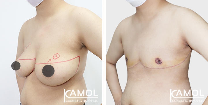 Chirurgie du Torse / Mastectomie 71 lg 64949599e32bc image