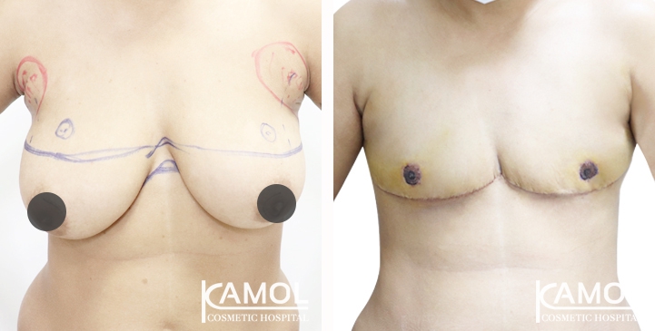 Chirurgie du Torse / Mastectomie 74 lg 64949599e5dc9 image