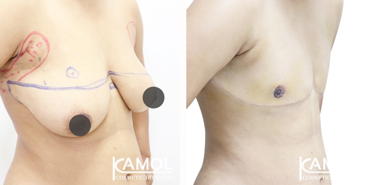 Chirurgie du Torse / Mastectomie 76 lg 64949599e7db7 image