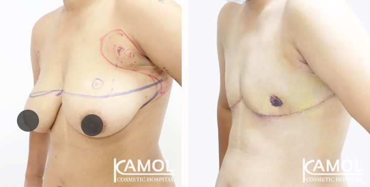 Chirurgie du Torse / Mastectomie 75 lg 64949599e9d78 image