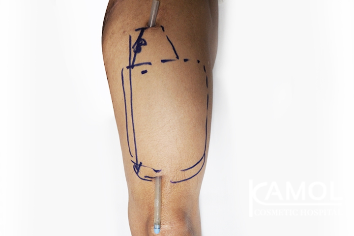 Faloplastia 3 lg 64949599f2268 image