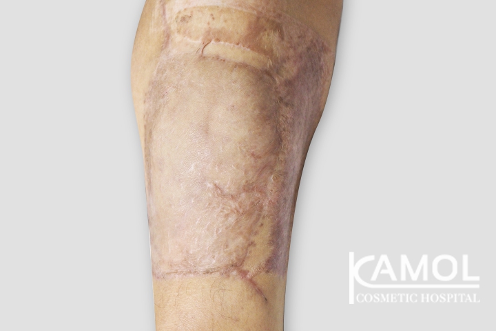 Faloplastia 10 lg 6494959a0e3aa image