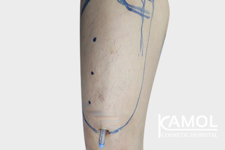 Faloplastia 22 lg 6494959a2f630 image
