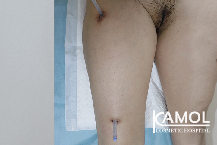 Faloplastia 24 lg 6494959a315e5 image