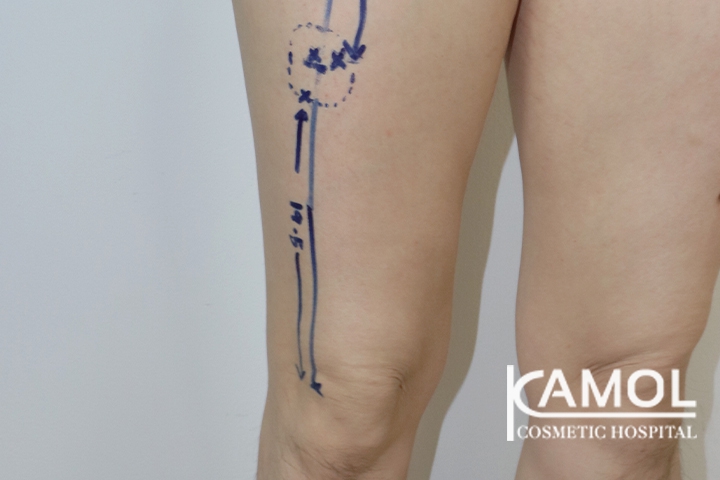 Faloplastia 25 lg 6494959a33542 image