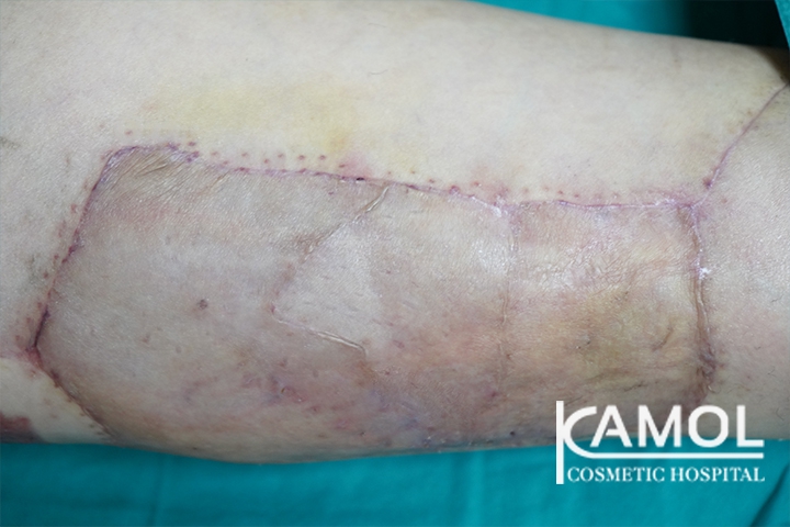 Faloplastia 23 lg 6494959a36fd2 image