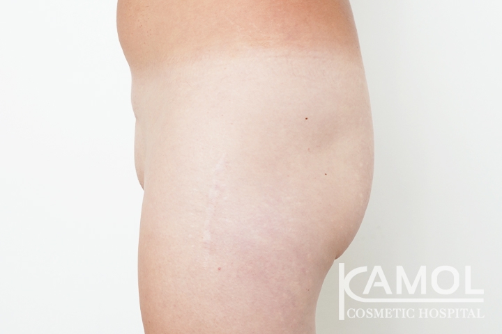 Faloplastia 36 lg 6494959a59d72 image