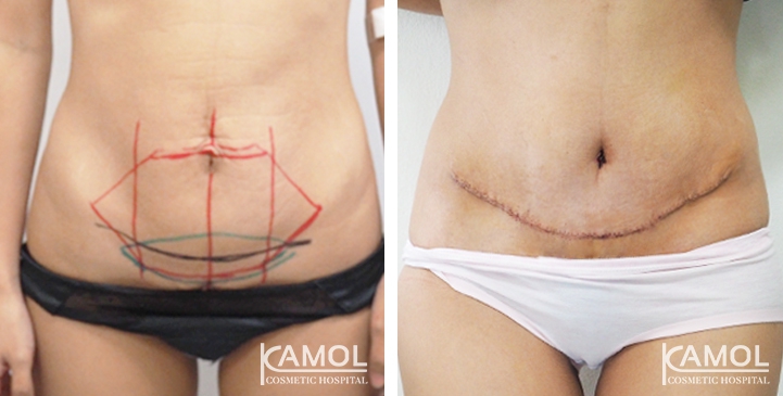 Contouring Corporeo / Lipectomia 19 lg 6494959acc54b image