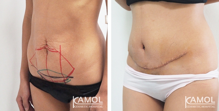 Contouring Corporeo / Lipectomia 23 lg 6494959ace600 image