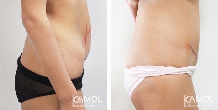 Contouring Corporeo / Lipectomia 21 lg 6494959ad44cc image