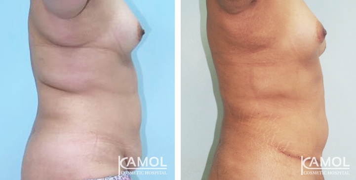 Contouring Corporeo / Lipectomia 28 lg 6494959adb038 image