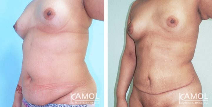 Contouring Corporeo / Lipectomia 27 lg 6494959add117 image