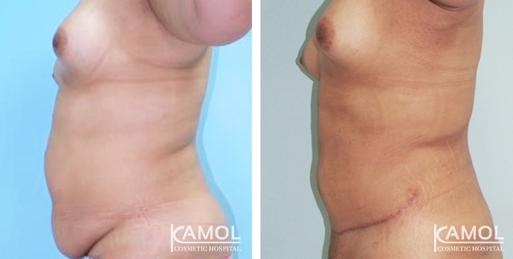 Contouring Corporeo / Lipectomia 26 lg 6494959adf230 image