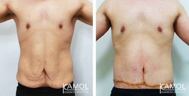 Contouring Corporeo / Lipectomia 31 lg 6494959ae1e97 image