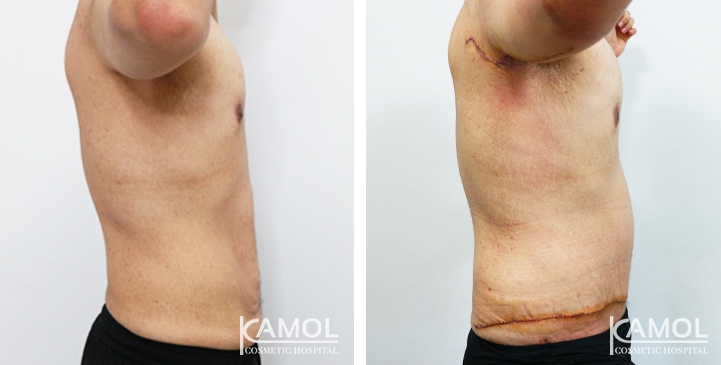 Contouring Corporeo / Lipectomia 34 lg 6494959ae5e76 image