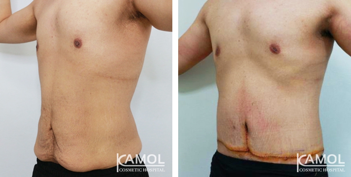 Contouring Corporeo / Lipectomia 33 lg 6494959ae7c2c image
