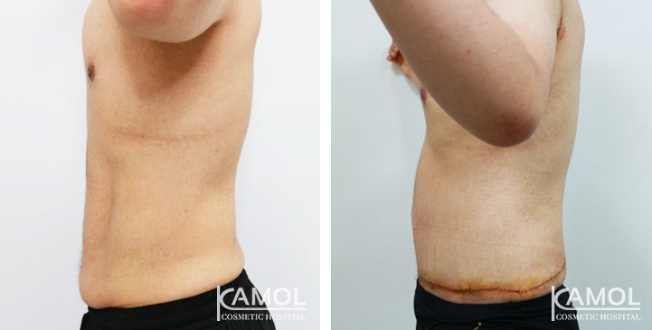 Contouring Corporeo / Lipectomia 32 lg 6494959ae99c1 image
