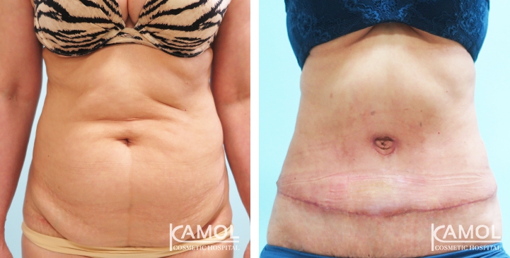 Contouring Corporeo / Lipectomia 37 lg 6494959aecc13 image