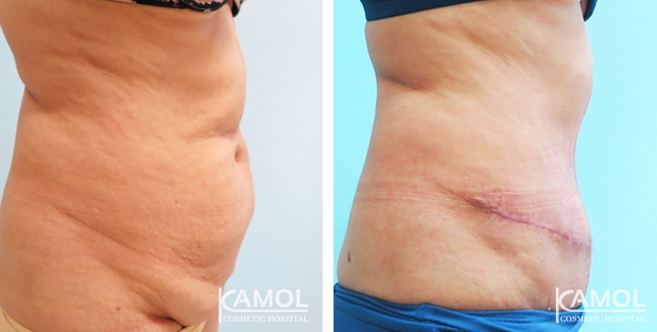 Contouring Corporeo / Lipectomia 40 lg 6494959af36ea image