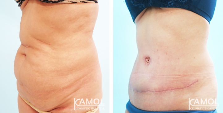 Contouring Corporeo / Lipectomia 39 lg 6494959b013ad image