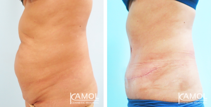 Contouring Corporeo / Lipectomia 38 lg 6494959b03320 image